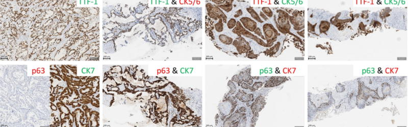 Histological and molecular plasticity of ALK-positive non-small-cell lung cancer under targeted therapy: a case report